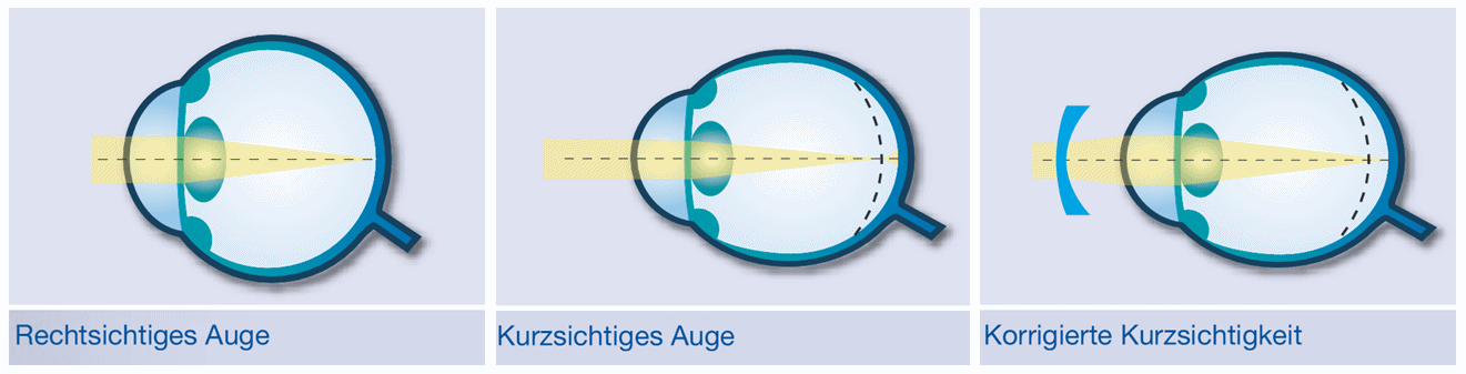 Kontaktlinsen umrechnen brillenstärke brillenwerte